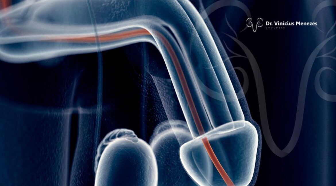 Reabilitação Peniana Após Prostatectomia